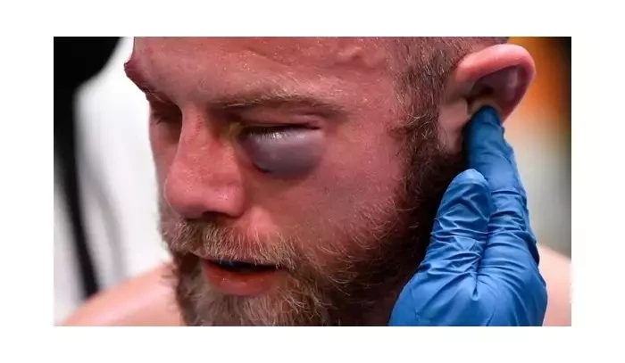 Brutální monokl! UFC bitvu mezi Smithem a Jaynesem musel ukončit lékař