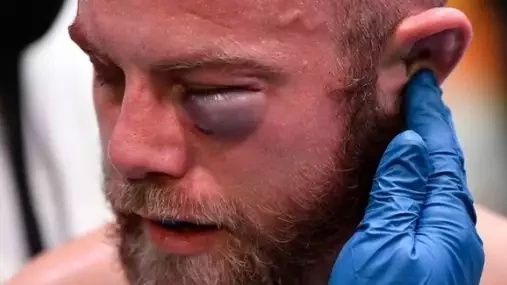 Brutální monokl! UFC bitvu mezi Smithem a Jaynesem musel ukončit lékař