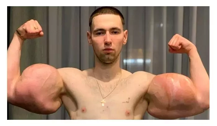 Zemře kvůli obřím napíchaným bicepsům? Ruský MMA zápasník musel ukončit kariéru, hrozí mu smrt!
